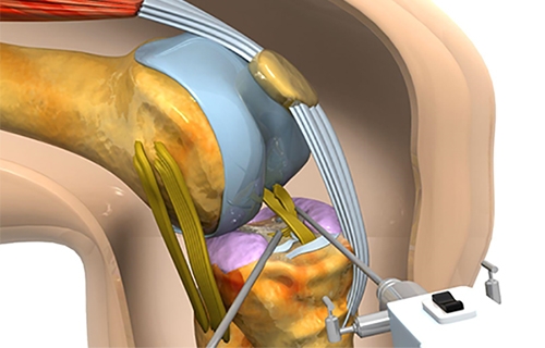 What Is Knee Balancing and Why It Matters in Knee Replacement