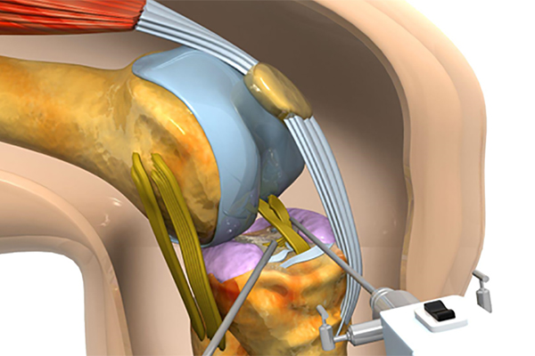 What Is Knee Balancing and Why It Matters in Knee Replacement