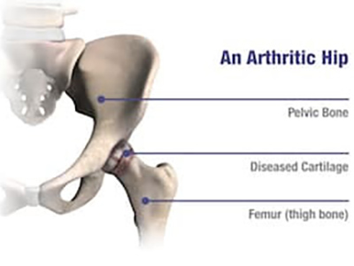 Arthritic Hip