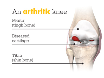 Mako SmartRobotics for Total Knee Replacement