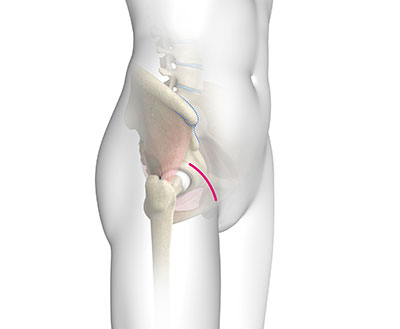 Bikini Incision Hip Replacement
