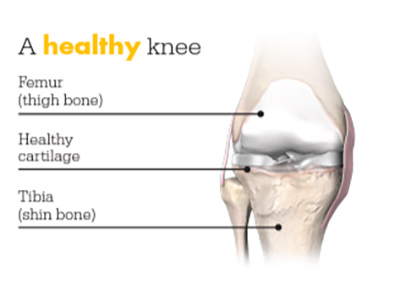 Mako SmartRobotics for Total Knee Replacement