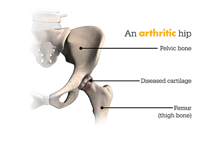 Mako Arthritic Hip
