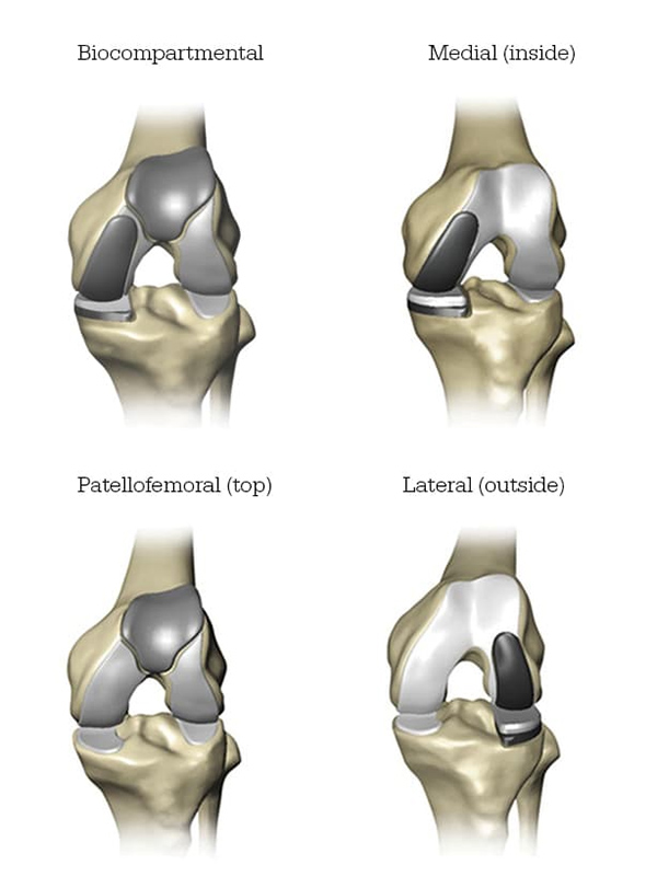 Mako Partial Knee Replacement