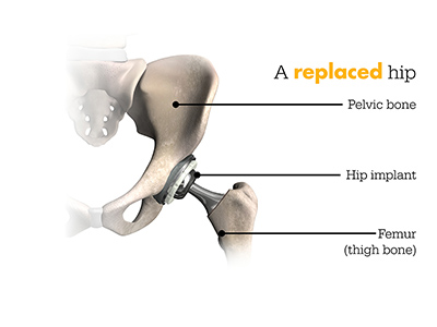 Mako Replaced Hip