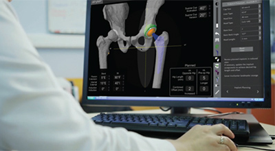 Mako SmartRobotics for Total Hip Replacement