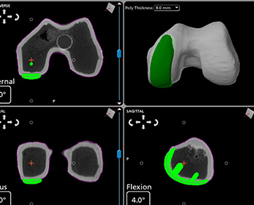 Partial Knee