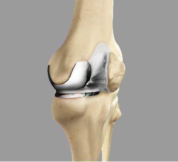 Partial Knee Replacement