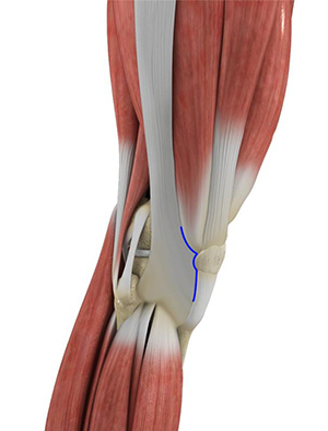 Subvastus Muscle Sparing Total Knee Replacement