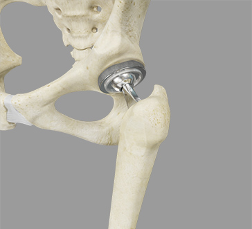 Total Hip Replacement