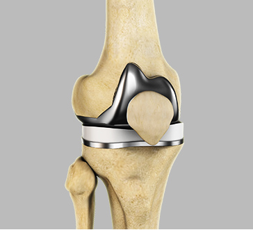 Total Knee Replacement